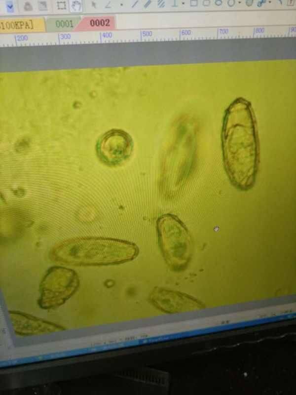 胆囊里面有虫怎么办,胆囊有虫什么症状