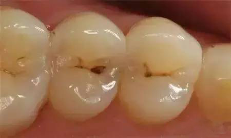 多颗门牙蛀牙烂洞怎么修复,10岁男孩多颗蛀牙怎么办