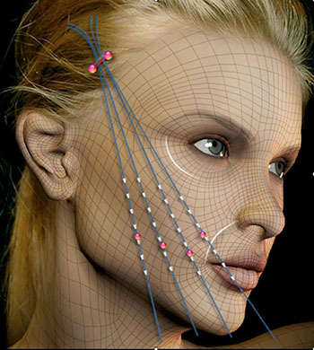 面部线雕提升手术全过程,面部线雕和拉皮的区别能维持多久