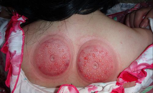 根据拔罐后皮肤的颜色鉴定你的身体到底是怎么了