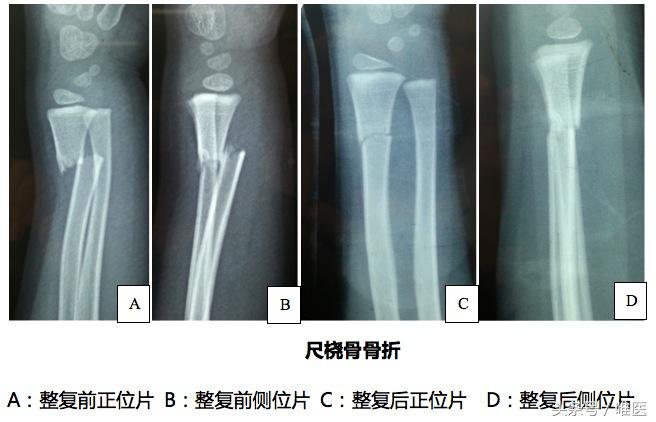 小孩尺桡骨骨折后期自我塑形,儿童尺骨桡骨远端骨折第九周