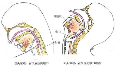 胃癌手术做完多久可以拔出胃管,胃癌手术后胃管拔早了
