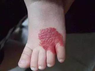 食管血管瘤能自愈吗,椎体血管瘤能自愈吗