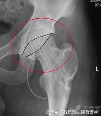 正常骨盆x线片详解,骨科医生只看报告单