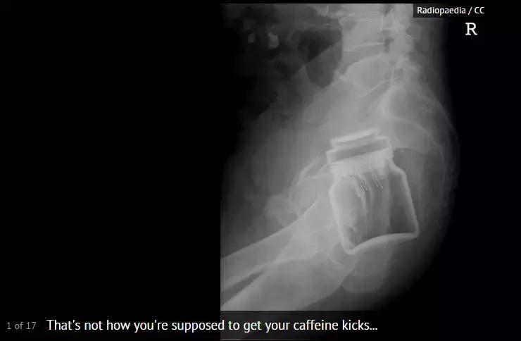 X光片里的体内异物，简直大开眼界