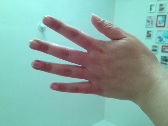 冻疮快速止痒消肿的药抹脚,什么中药煮水泡手可以治冻疮