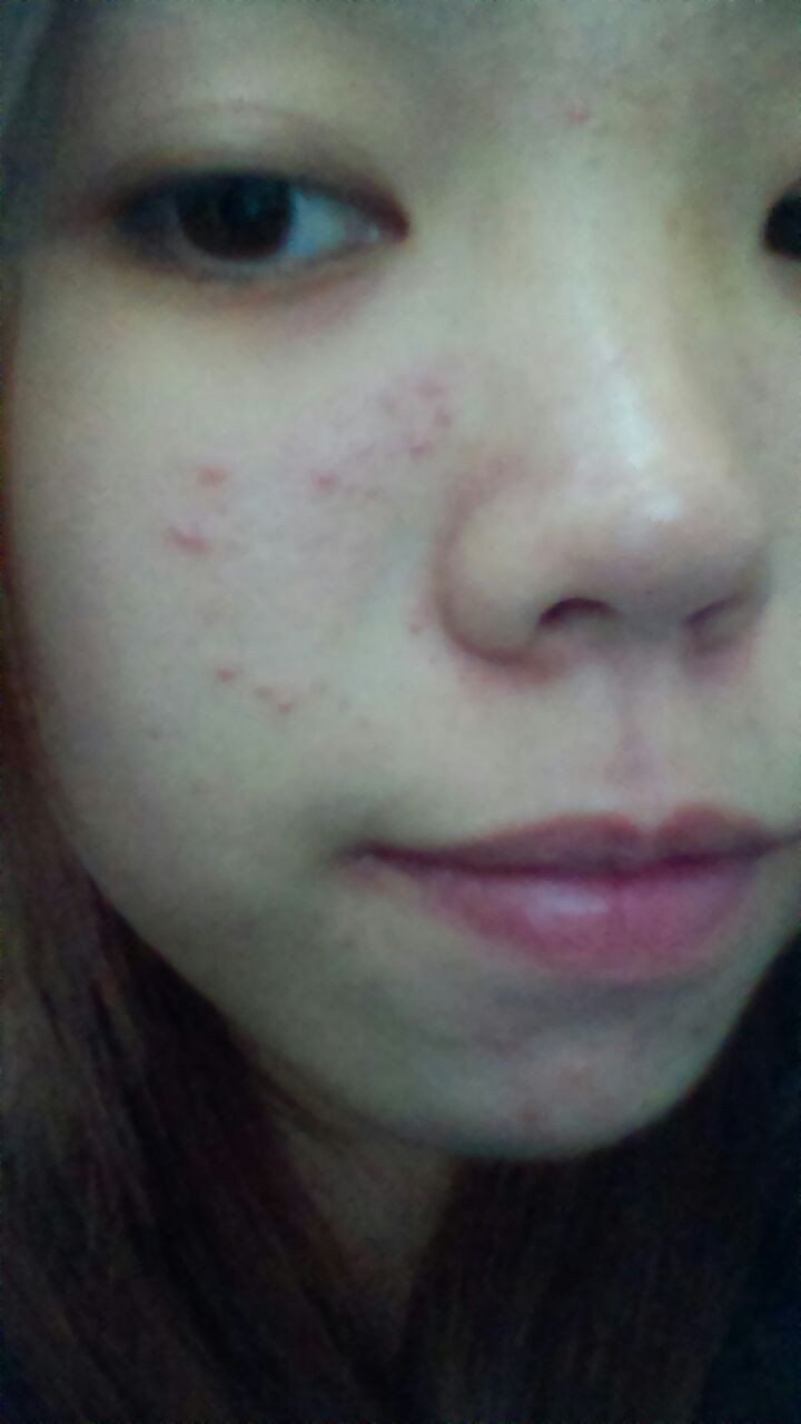 脸颊下巴老是长痘痘怎么治疗,脸颊跟下巴长痘痘用什么药膏