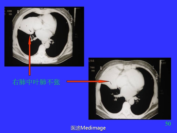 胸部ct扫描双肺未见明显异常,胸部ct报告心脏不大正常吗