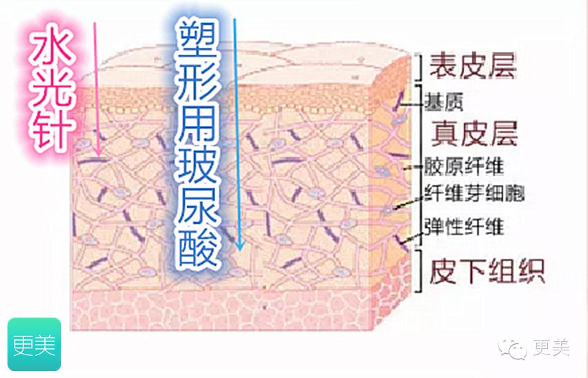 水光针和隆鼻用的玻尿酸有区别吗？