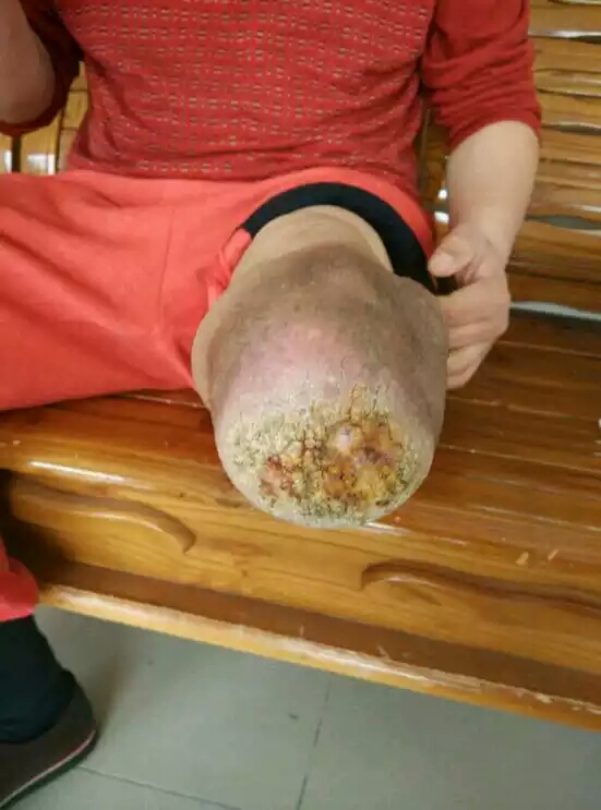 残疾朋友须要注意了：硅胶套，我须要配戴吗？