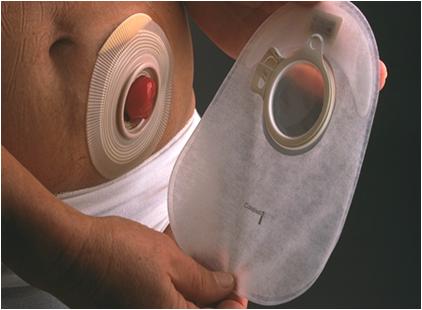 造口脱垂原因及处理方法,造口旁疝会诱发造口脱垂吗