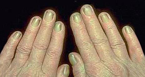 指甲的变化意味着身体的健康状况,当指甲发绿发脓的时候要怎么处理