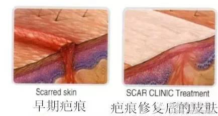 伤疤修复最佳时间和注意事项