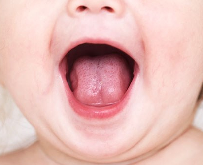关于新生儿鹅口疮，这些你不得不知