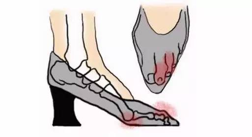 大拇脚趾盖歪长是怎么回事,锤状脚趾弯曲怎么矫正