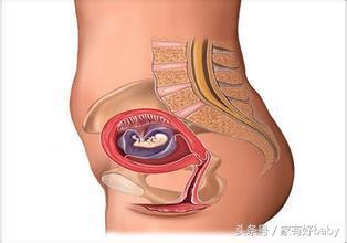 怎么样预防破水,产前如何预防妊娠纹