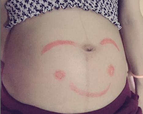 孕妇肚皮痒一抓起疙瘩是什么原因,孕妇肚皮痒痒是快要生了吗