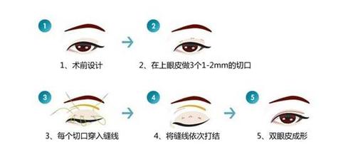 韩式三点双眼皮怎么做,做过韩式三点双眼皮能改成全切吗