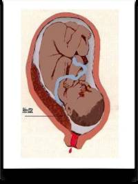 中央性前置胎盘为什么会大出血,前置胎盘16周大出血很多血块