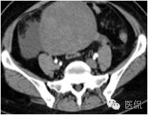 病例丨病理结果「医看」有奖阅片大赛病例资料8：右侧卵巢纤维瘤#医学影像#