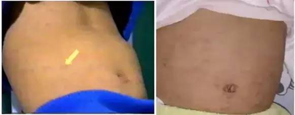 诊断麻疹最快速的方法,麻疹怎么做检测