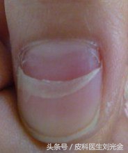 宝宝指甲脱落怎么回事,30个月宝宝指甲脱落是怎么回事