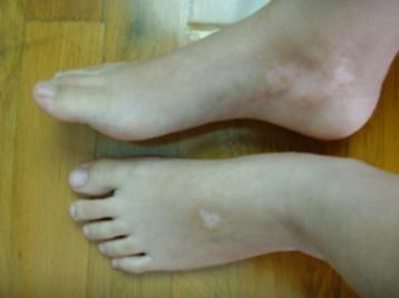 白癜风会遗传下一代吗怎样预防,白癜风好了以后怎么预防复发