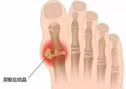 痛风最好的治疗与预防复发的方法,痛风怎么治疗和预防最好