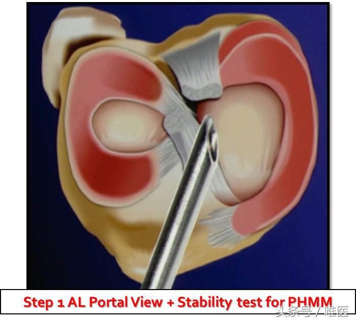 膝关节内侧后角半月板1度损伤,右膝关节内侧半月板后角变性损伤