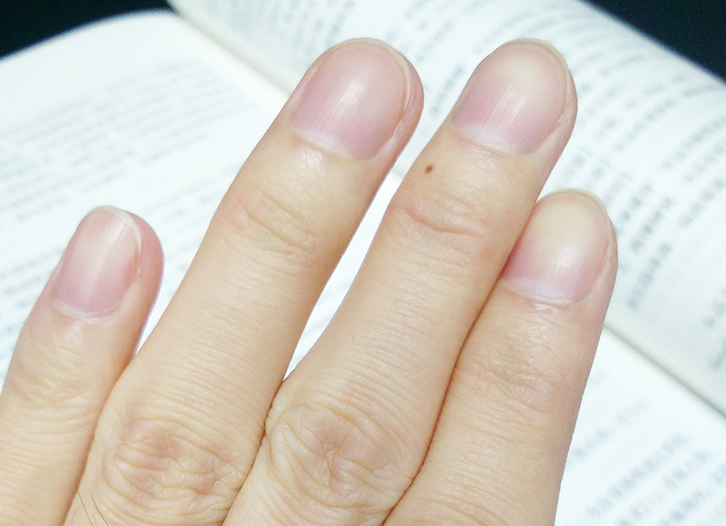 皮痹与硬皮病是一回事吗,硬皮病中药由寒凉引起的治疗方法