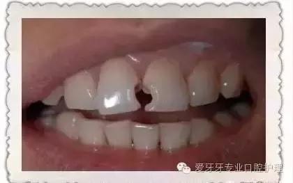 不同材质的牙冠的价格,不同价位的烤瓷牙冠