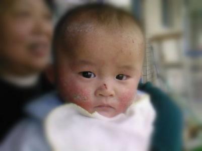 育儿常识2-3岁,婴幼儿湿疹护理四大常识