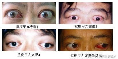 甲状腺结节怎么区分甲亢和甲减,甲亢转为甲减严重吗