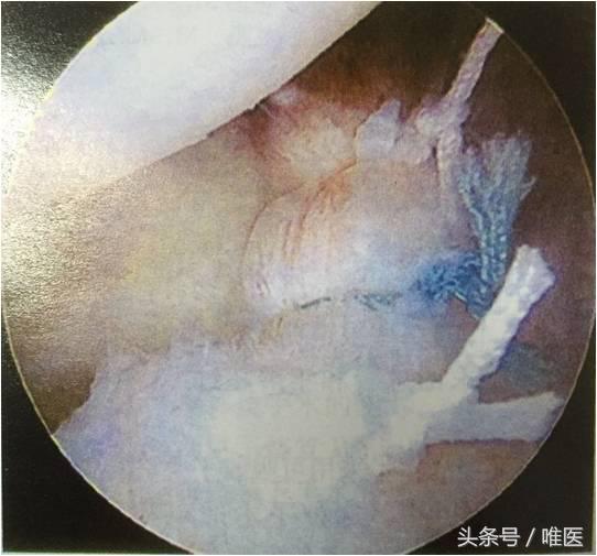 肩关节镜修复方法,肩关节镜下半骨道修复技术