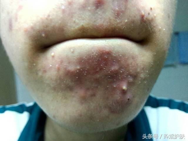 下巴长痘痘痘印怎么消除最快,下巴长痘痘如何祛除痘印小妙招