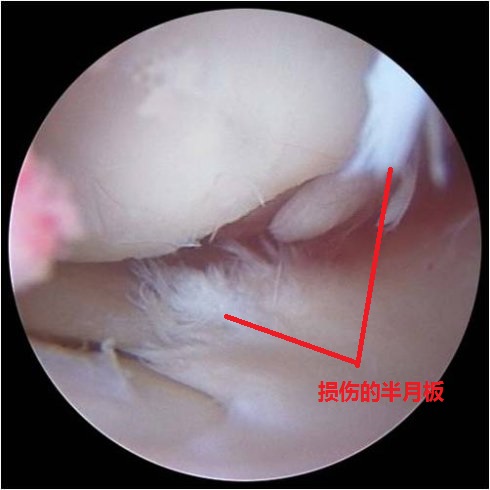 在部队训练膝盖疼痛怎么处理,篮球保护膝盖训练方法