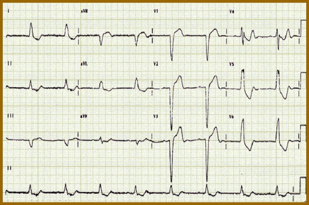 心电图st段呈j点型抬高是什么意思,心电图st段抬高一定是心梗吗