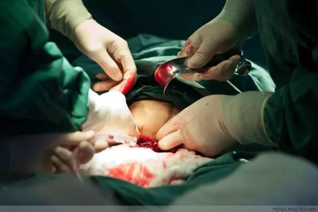 剖腹产恢复很好的照片,剖腹产完全恢复照片