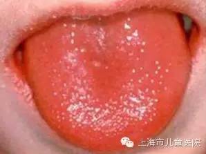 孩子高烧不退当心川崎病,孩子高烧不退当心得了川崎病
