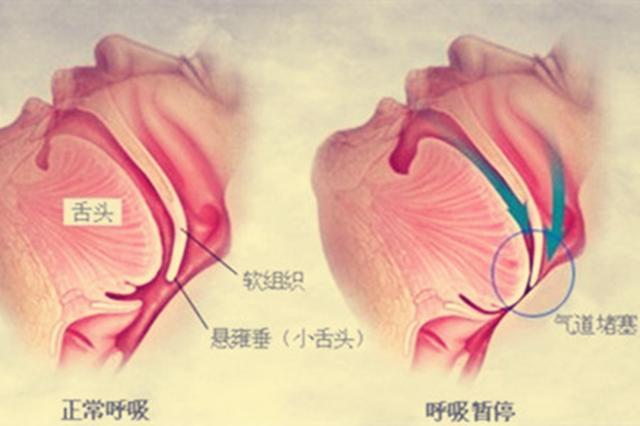 云中飞止鼾器测评,揭秘云中飞智能止鼾器真假