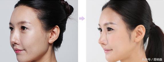 3d手术鼻子整形,鼻子整形手术亲身经历