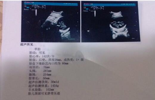 b超单怎么看单双,如何看懂b超单图片