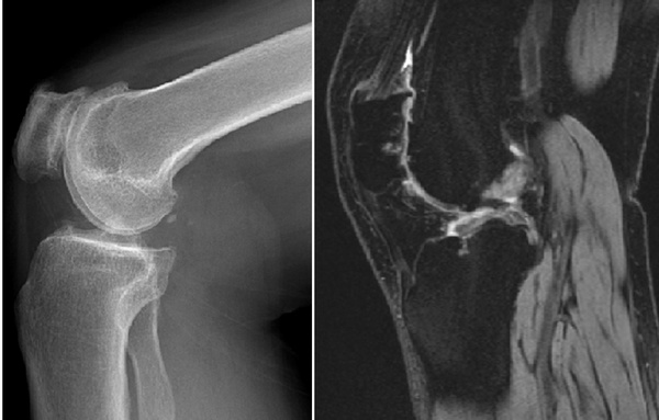 髌骨软化症最佳的治疗方法,夹球可以锻炼髌骨软化症吗