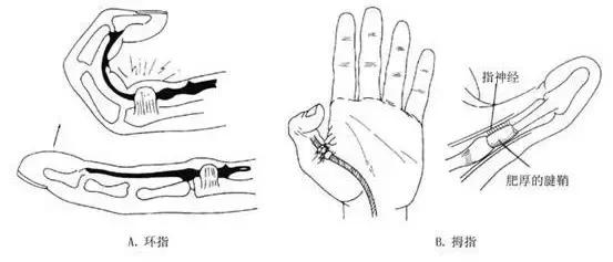 玩手机玩得大拇指痛怎么办,手机玩多了手指肿痛