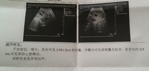 19周b超数据该怎么看,孕妇b超单数据解析