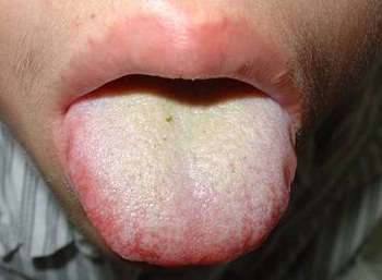 舌头有突起是什么病,舌头有这些表现或是疾病征兆