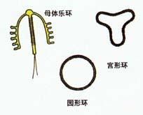 上环的手术过程要多长时间,上环十年手术全过程和时间