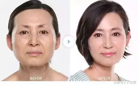 超声刀值得做吗 (超声刀怎么样啊)