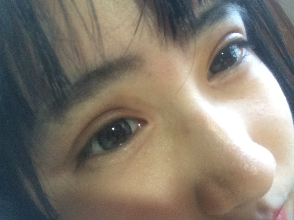 抽脂双眼皮做完眼睛有褶,割双眼皮肿成一条缝