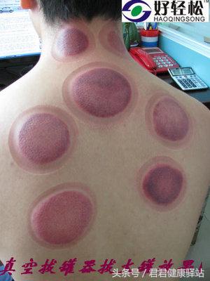 拔火罐印记是灰白颜色为什么,拔火罐的印子颜色代表了什么